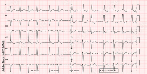 Pathological 12-lead ECG, right branch block, left branch hemiblock and atrial fibrillation