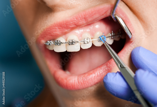 Close up of woman with brackets receiving dental braces treatment in clinic. Orthodontist using dental mirror and forceps while putting orthodontic braces on patient teeth. Concept of dentistry.