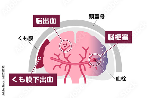 脳卒中 (脳梗塞・脳出血・くも膜下出血) の原因と症状 図解ベクターイラスト