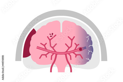 Types of human brain stroke vector illustration