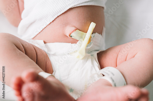 Newborn umbilical stump