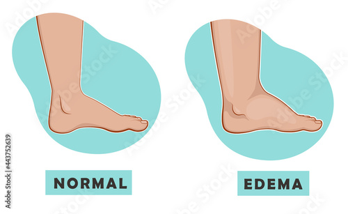 A swollen foot and ankle and a normal foot. Edema. Vector illustration