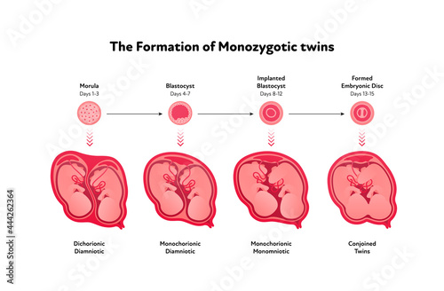 Embryo in womb medical diagram. Vector flat healthcare illustration. Formation of monozygotic twins. Design for health care, education.