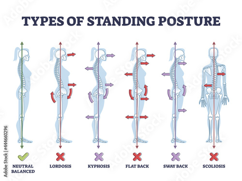 Types of standing postures and medical back pathology set outline diagram. Educational labeled collection with spine curvature problems compared to healthy neutral balanced example vector illustration