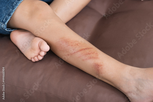 Wounds, scratches and abrasions on skin of child leg. Children injury.
