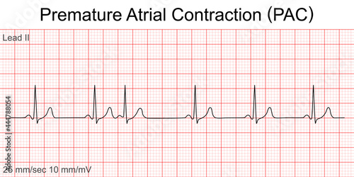 Electrocardiogram show Premature Atrial Contraction (PAC) pattern ,Heart beat ,ECG ,EKG interpretation ,Vital sign ,Life line ,Medical healthcare symbol.