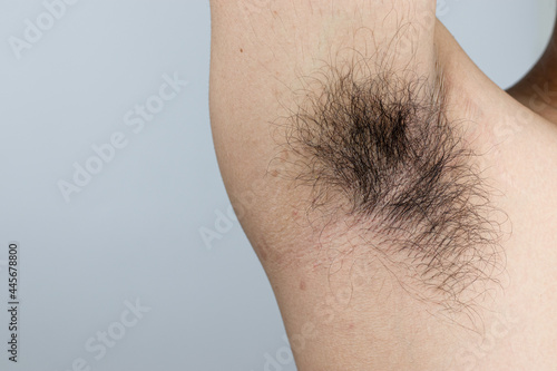 A man who raised his arms to show off his armpits full of long hair and the marks of a rash.