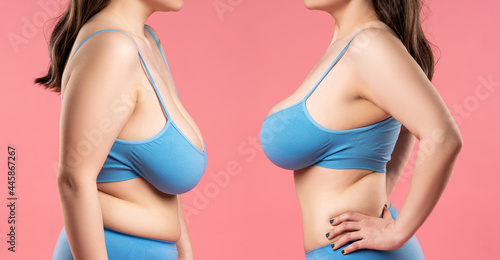 Before and after breast augmentation concept, woman with very large silicone breasts after correction surgery