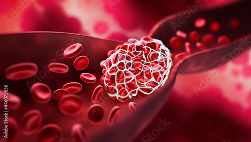 Blood clot blocking a blood vessel