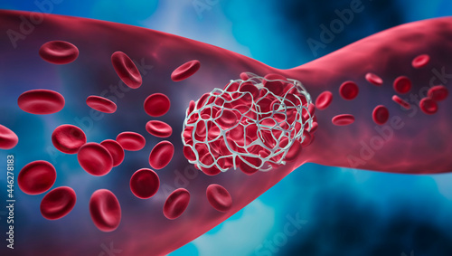 Blood clot blocking a blood vessel