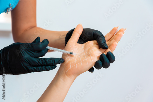 Cosmetologist makes injections of botulinum toxin on the female palm against hyperhidrosis. Hand with white drawn grid. Close up. Concept of cosmetology
