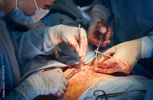 Close up of doctor and assistant in gloves placing sutures after tummy tuck surgery in hospital. Medical workers performing abdominal plastic surgery. Concept of abdominoplasty and cosmetic surgery.