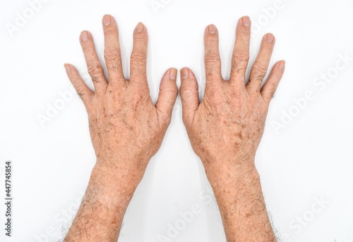 Age spots on hands of Asian elder man. They are brown, gray, or black spots and also called liver spots, senile lentigo, solar lentigines, or sun spots.