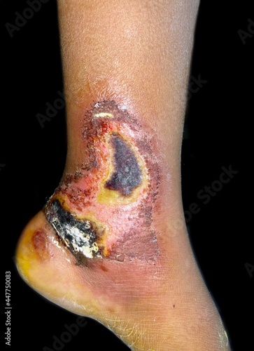 Burn wound with granulatuon tissues surrounded by scabs and slight cellulitis in left leg of Southeast Asian child