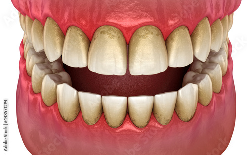 Tartar and bactrail tooth plaque, jaw inflammation. Medically accurate 3D illustration of human teeth treatment