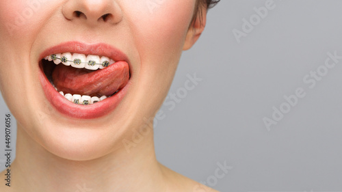 Orthodontic treatment. Closeup ceramic and metal brackets on teeth. Female smile with braces. Dental care concept.