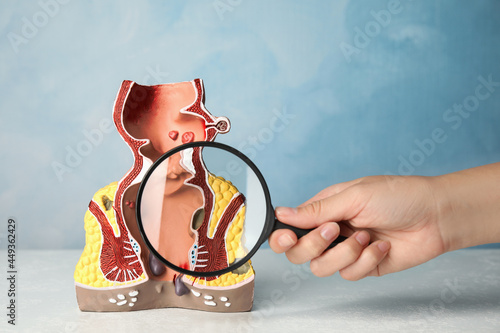 Doctor with magnifying glass showing model of unhealthy lower rectum on light blue background, closeup. Hemorrhoid problem