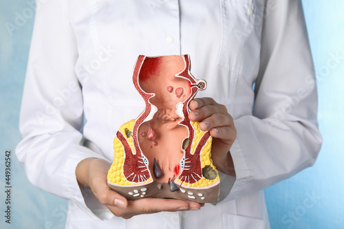 Doctor holding model of unhealthy lower rectum on light blue background, closeup. Hemorrhoid problem