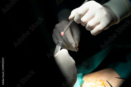 concentrated professional surgical doctor team operating surgery a patient in the operating room at hospital. tumor cancer. surgical biopsy specimens. healthcare and medical concept.