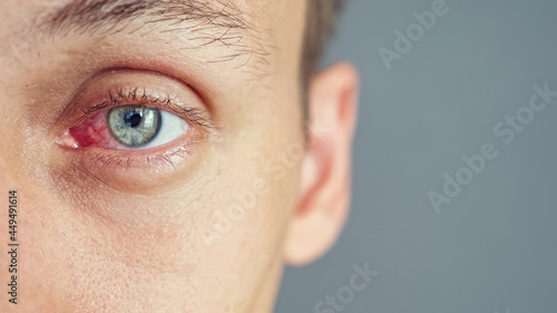 Close up of the red eye of a man affected by an infection, copy space