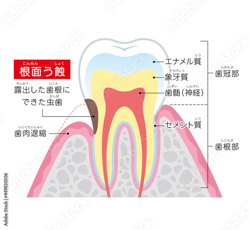 根面う蝕の図解イラスト