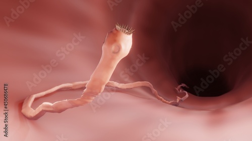 Tapeworm in the intestine