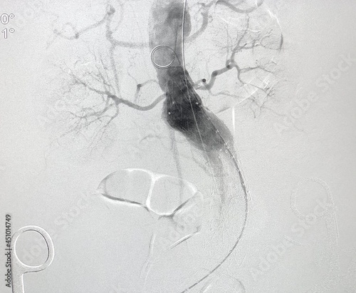 Angiogram of aorta shown Infra-renal abdominal aortic aneurysm (AAA) during endovascular aortic aneurysm repair (EVAR) procedure.