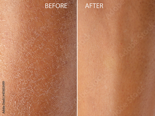 Dry skin before and after moisturizing treatment