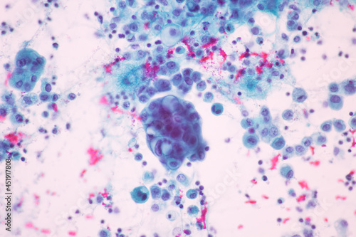 View in microscopic of Abnormal human cervix cells.Squamous epithelium cells.Superficial and intermediate epithelial cells.Cytology and pathology laboratory department.Magnification 400 X