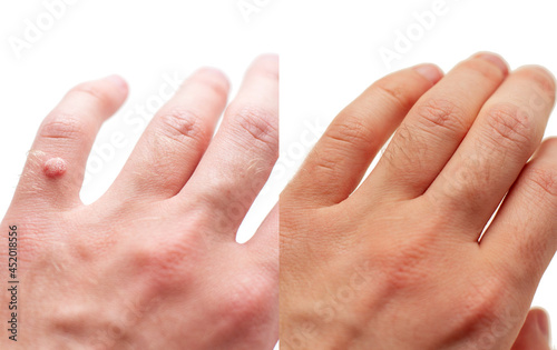 Laser treatment for wart removal before and after.