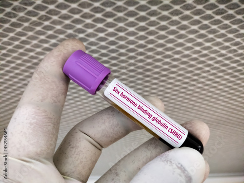 Blood sample for sex hormone binding globulin or SHBG test, diagnosis of abnormal testosterone level