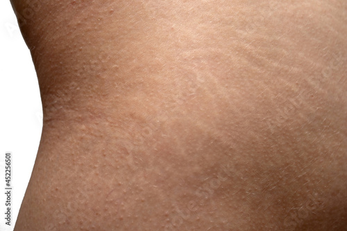 Stretch marks on woman's buttocks skin