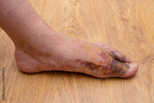 Swollen injured male limb on the left foot with hematoma when a heavy object falls on the leg