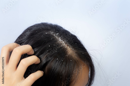 Dandruff problem. A girl with itchy head. Dandruff on the hair. Hair disease seborrhea. Fatty Dandruff.