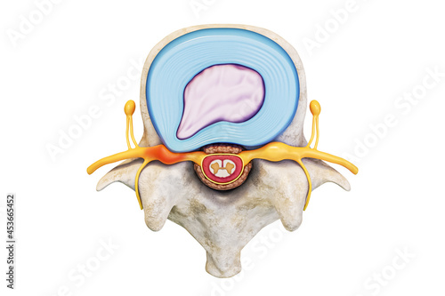 Superior view of human lumbar vertebra with herniated disc and spinal cord isolated on white background with copy space 3D rendering illustration. Anatomy, medical, backbone pathology concepts.
