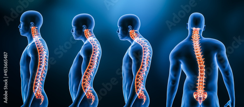 Three main curvatures of the spine disorders or deformities on male body: lordosis, kyphosis and scoliosis 3D rendering illustration. Human anatomy, back injury or disease, medical concepts.