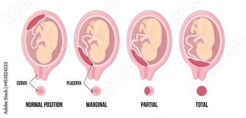 Different Placental Locations During Pregnancy. Normal, marginal, partial and total previa.