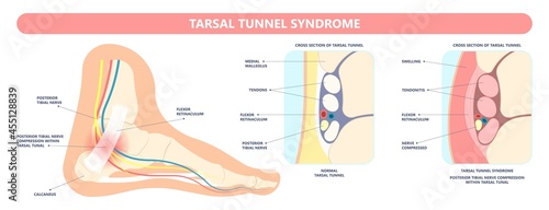 Tarsal tunnel syndrome flat feet flatfoot tibial tear running ankle bone tendon nerves pain foot compresses fallen arches vein cyst swollen spur carpal heel injury trauma torn inflamed adult