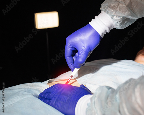 Doctor surgeon with a scalpel in his hand before bowel surgery in a patient, close-up. Small intestine part removal concept and bowel disease treatment. Copy space for text