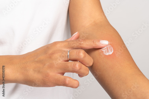 Allergic reaction, itch, allergy, dermatiti concept. Close up of woman applying cream or ointment on swell skin after insect mosquito bites, isolated on grey studio background. 