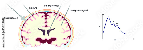 Intracranial Pressure Monitoring (ICP) monitoring device placement in a Coronal section.