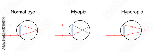 Illustration of light diagram on normal eye, myopia, and hyperopia.