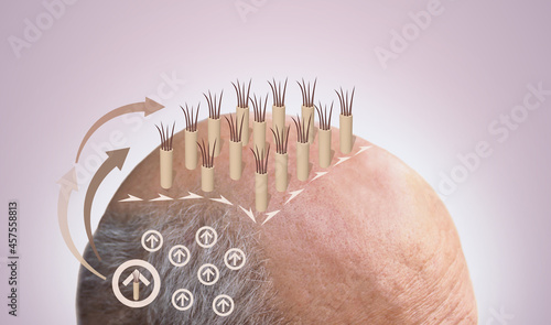 Methods of hair transplantation fut vs fue with infographic elements of illustration.