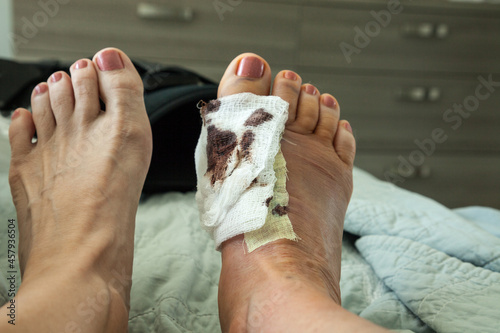 Bloody bandages on a foot with stiches after a bunion surgery