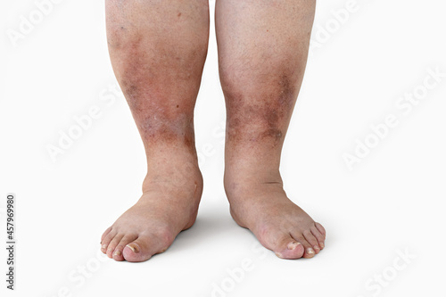 Swelling of the leg with inflammation in diabetic nephropathy in a woman, close-up.