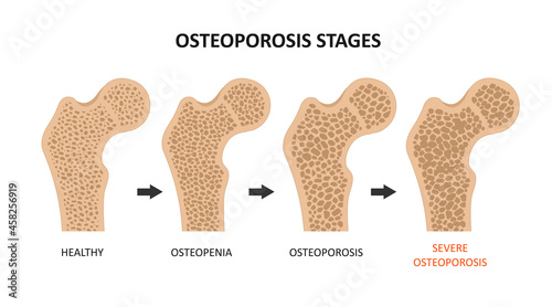Osteoporosis stages. Bone spongy structure vector illustration, normal, osteopenia and osteoporosis