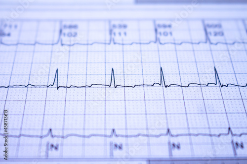 Electrocardiogram with cardiac arrhythmia. Atrial fibrillation recorded as the origin of many cerebrovascular accidents or strokes.