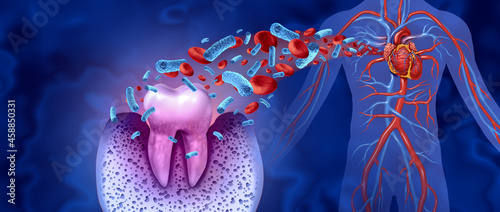 Tooth Decay Disease