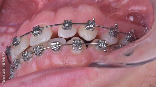 Dental tooth brackets In-Oral Photo Protocol