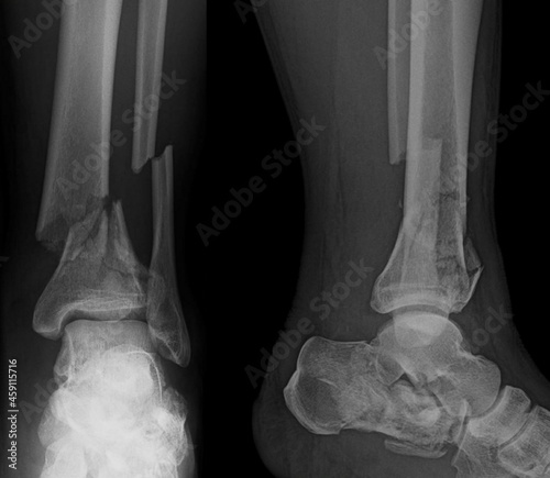 x ray of a broken foot cominutive fracture on tibia and fibula